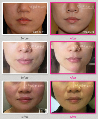 A before and after photo of a woman 's face