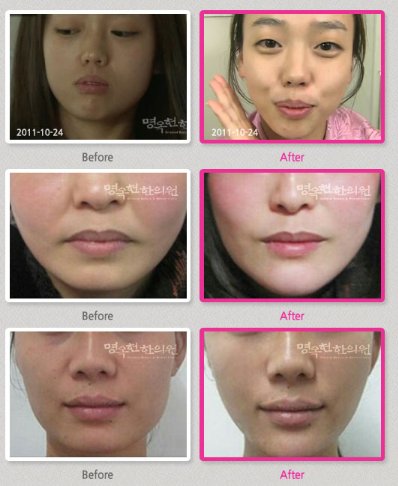 A before and after photo of a woman 's face
