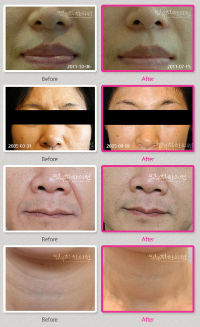 A before and after photo of a woman 's face
