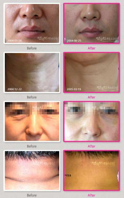 A before and after photo of a woman 's face