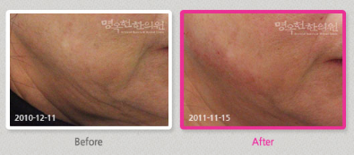 A before and after photo of a woman 's face