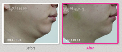 A before and after photo of a woman 's face