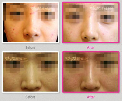 A before and after photo of a woman 's face