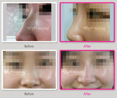 A before and after photo of a woman 's nose