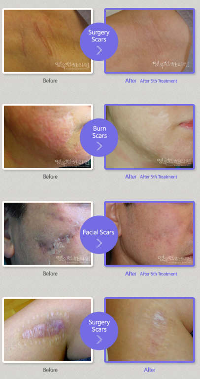 A before and after picture of surgery scars on a woman 's face