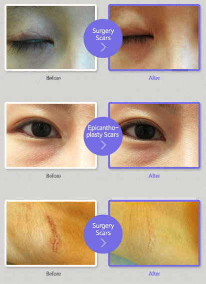 A before and after picture of a woman 's eye