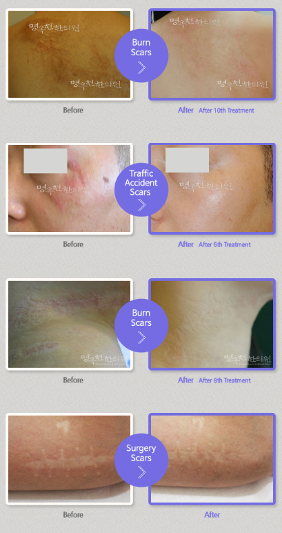 A picture of a person 's face with a purple circle that says free acne scans
