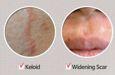 A picture of a person 's face and a picture of a widening scar