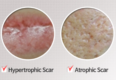 A picture of a hypertrophic scar and an atrophic scar