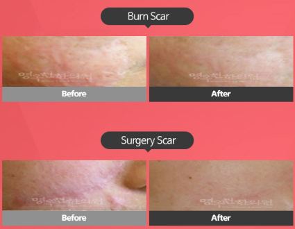 A before and after picture of a burn scar and a surgery scar.