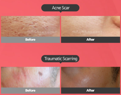 A before and after picture of an acne scar and a traumatic scarring.
