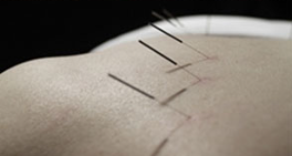 A person is getting acupuncture on their back.