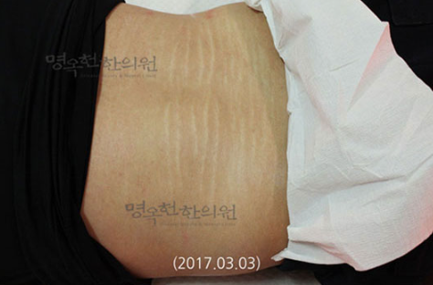 A woman 's stomach has a lot of stretch marks on it