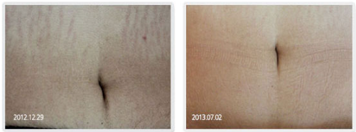 A before and after picture of a woman 's stomach with stretch marks.