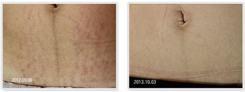 A before and after picture of a woman 's stomach with stretch marks.