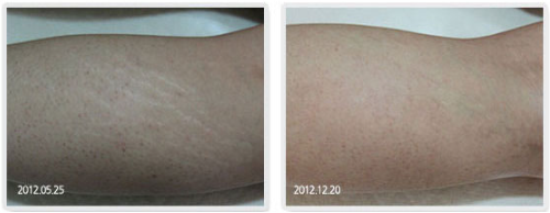 A before and after photo of a person 's arm