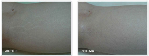 A before and after photo of a person 's arm