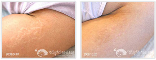 A before and after photo of a person 's arm with stretch marks.