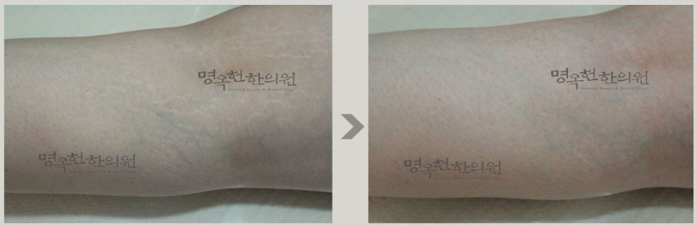 A before and after picture of a person 's arm