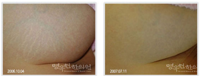 A before and after photo of a person 's skin