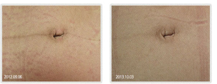 A before and after picture of a woman 's stomach.