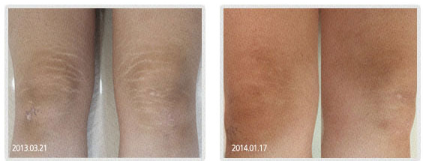 A before and after photo of a person 's knee