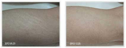 A before and after photo of a person 's arm