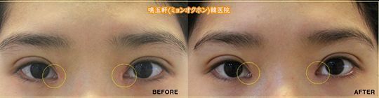 A before and after photo of a person 's eyes