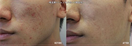 A before and after photo of a man 's face