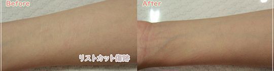 A before and after picture of a person 's arm.