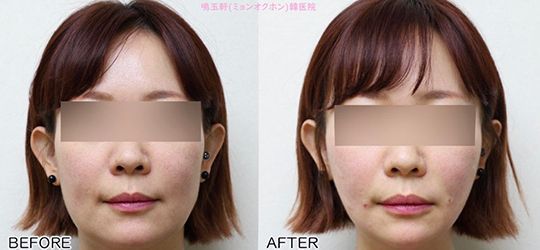 A before and after photo of a woman 's face.