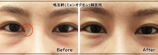 A before and after picture of a woman 's eyes.