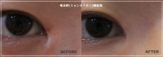 A before and after picture of a person 's eyes