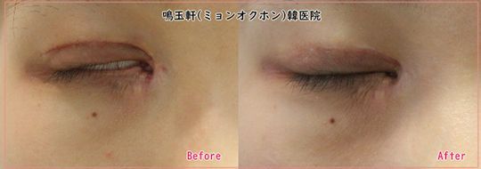 A before and after picture of a woman 's eye.