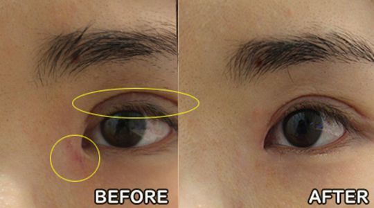 A before and after picture of a woman 's eye