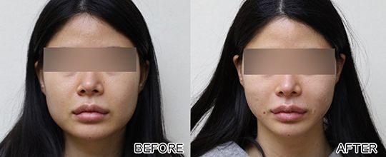 A before and after photo of a woman 's face