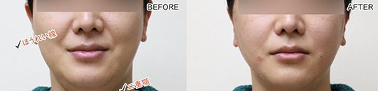 A before and after photo of a man 's face.
