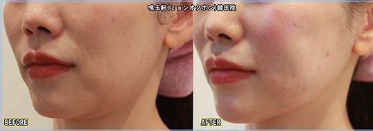 A before and after photo of a woman 's face