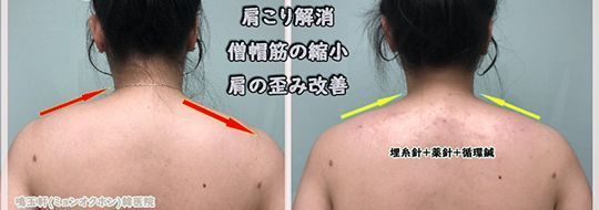 A woman 's back is shown in a before and after photo.