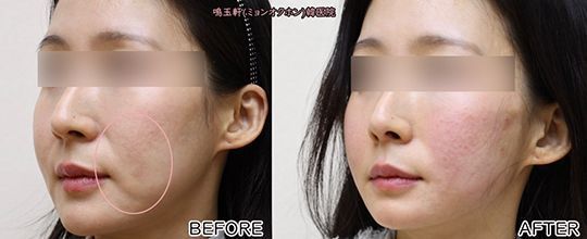 A before and after photo of a woman 's face.