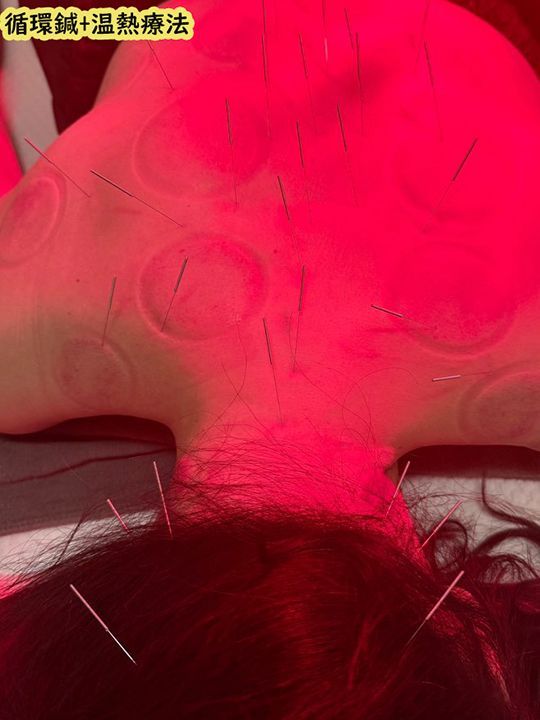 A woman is getting acupuncture treatment on her neck.