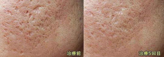 A before and after photo of a person 's face