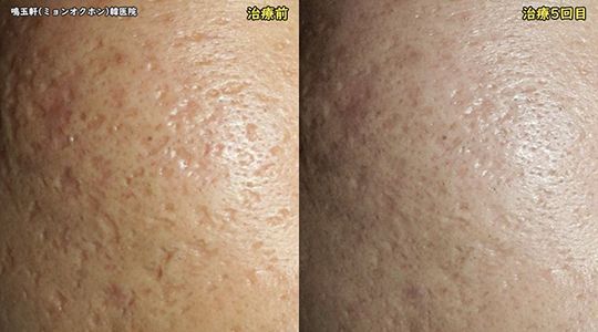 A before and after picture of a person 's face with acne.