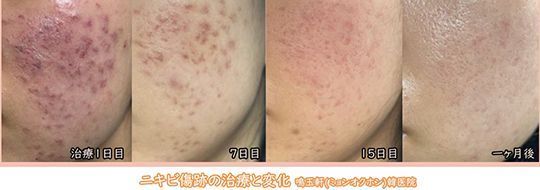 A before and after photo of a person 's face
