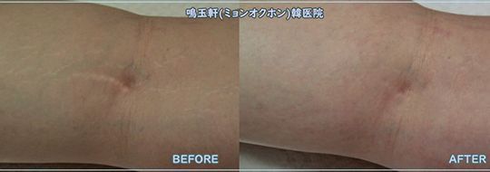 A before and after picture of a person 's wrist with a scar.