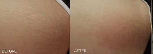 A before and after picture of a person 's skin