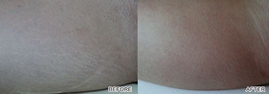 A before and after picture of a person 's skin
