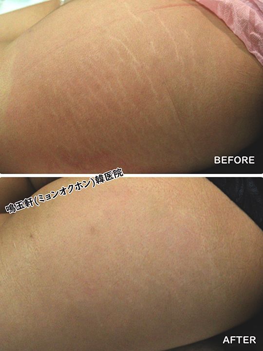 A before and after photo of a woman 's leg