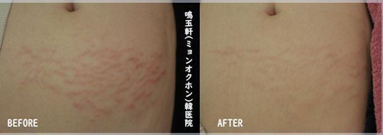 A before and after picture of a person 's stomach