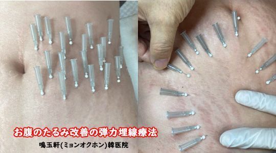 A person is getting acupuncture on their stomach